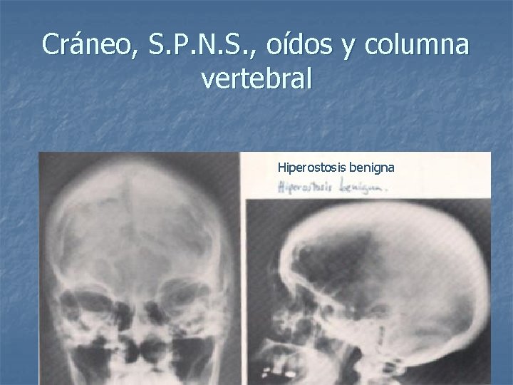 Cráneo, S. P. N. S. , oídos y columna vertebral Hiperostosis benigna 