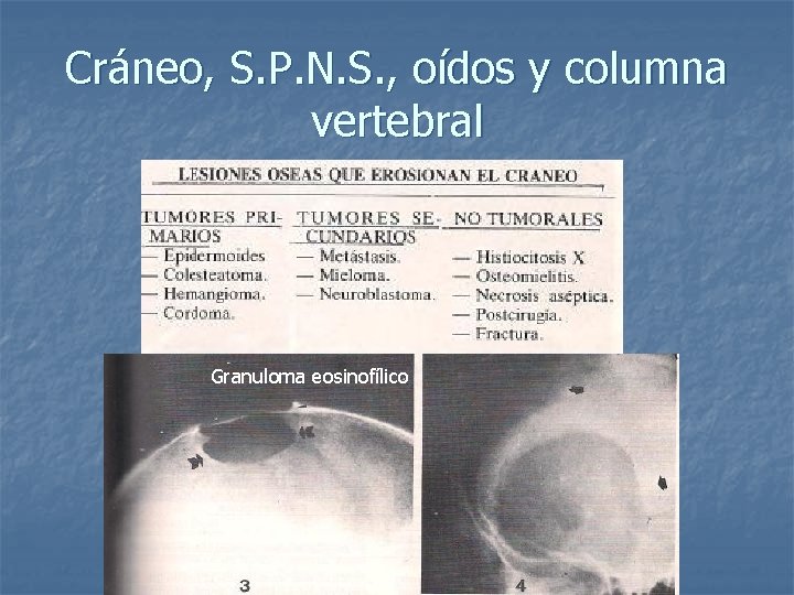 Cráneo, S. P. N. S. , oídos y columna vertebral Granuloma eosinofílico 