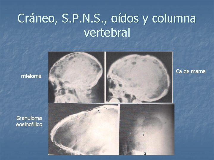Cráneo, S. P. N. S. , oídos y columna vertebral mieloma Granuloma eosinofilico Ca