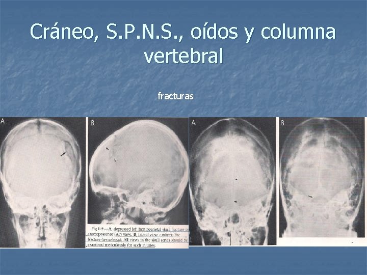 Cráneo, S. P. N. S. , oídos y columna vertebral fracturas 