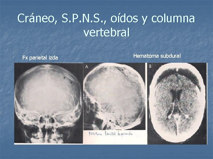 Cráneo, S. P. N. S. , oídos y columna vertebral Fx parietal izda Hematoma
