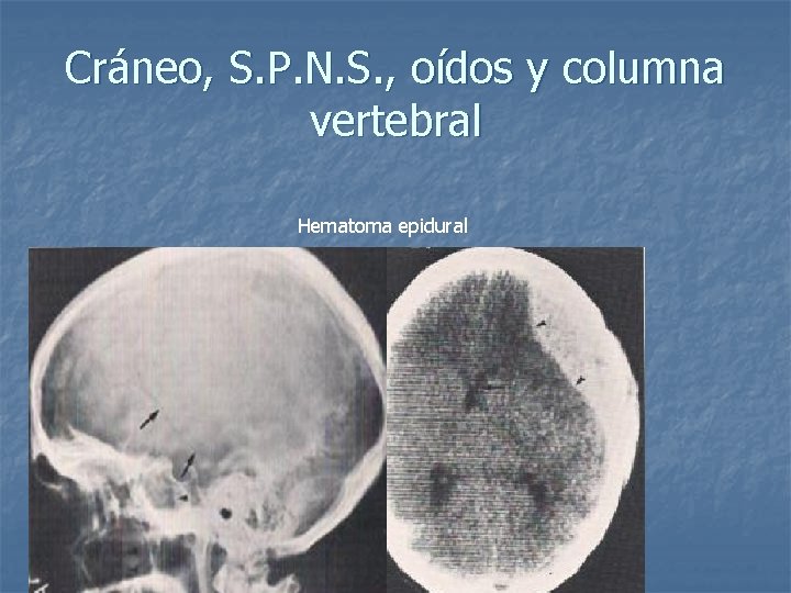 Cráneo, S. P. N. S. , oídos y columna vertebral Hematoma epidural 