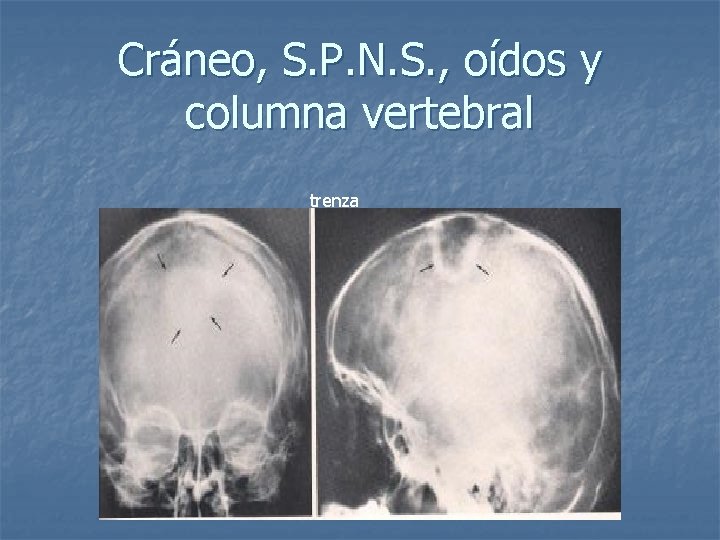 Cráneo, S. P. N. S. , oídos y columna vertebral trenza 