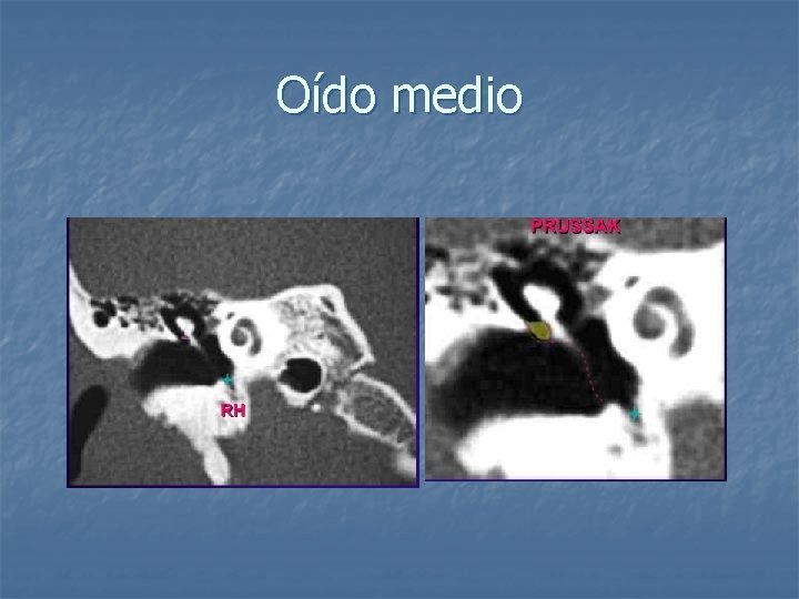 Oído medio 