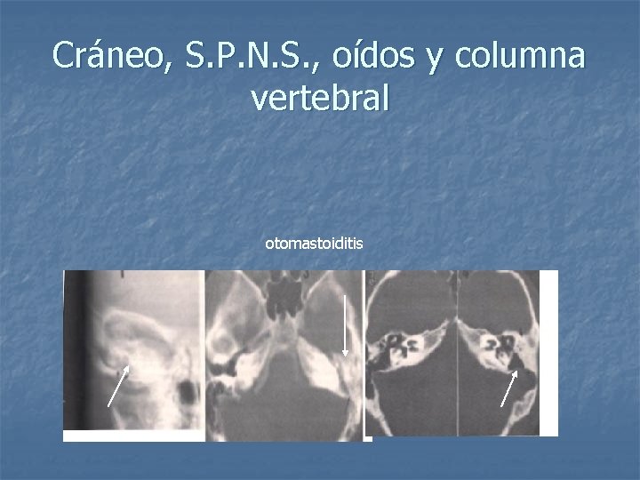 Cráneo, S. P. N. S. , oídos y columna vertebral otomastoiditis 