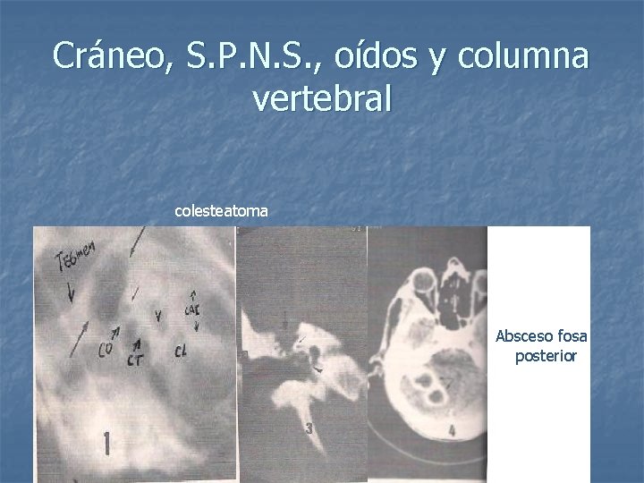 Cráneo, S. P. N. S. , oídos y columna vertebral colesteatoma Absceso fosa posterior