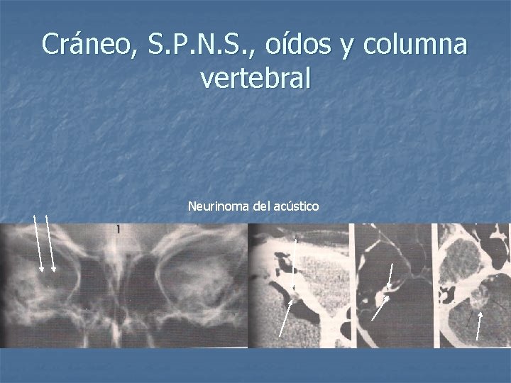 Cráneo, S. P. N. S. , oídos y columna vertebral Neurinoma del acústico 