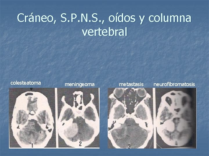 Cráneo, S. P. N. S. , oídos y columna vertebral colesteatoma meningeoma metastasis neurofibromatosis