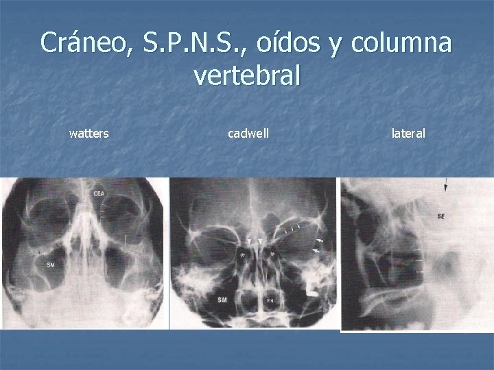 Cráneo, S. P. N. S. , oídos y columna vertebral watters cadwell lateral 