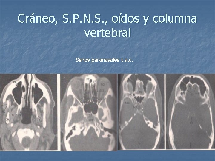 Cráneo, S. P. N. S. , oídos y columna vertebral Senos paranasales t. a.