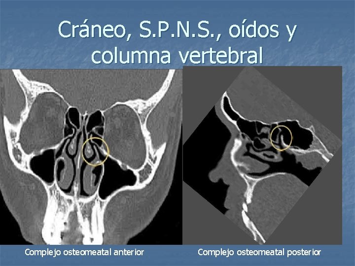 Cráneo, S. P. N. S. , oídos y columna vertebral Complejo osteomeatal anterior Complejo