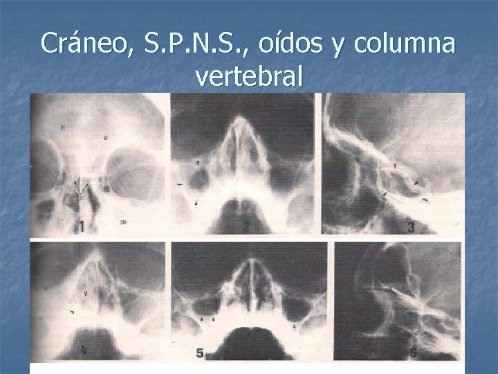 Cráneo, S. P. N. S. , oídos y columna vertebral 