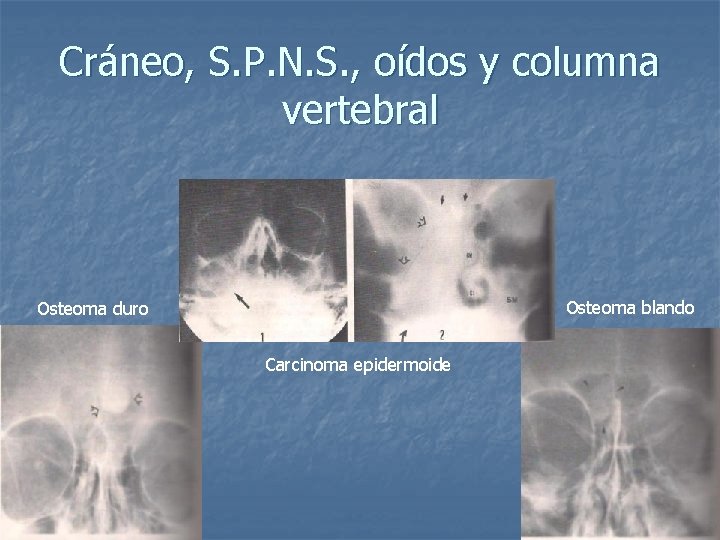 Cráneo, S. P. N. S. , oídos y columna vertebral Osteoma blando Osteoma duro