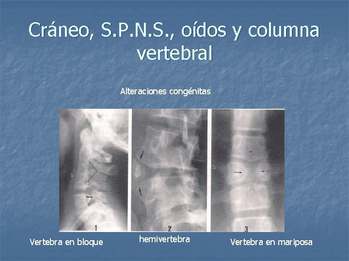 Cráneo, S. P. N. S. , oídos y columna vertebral Alteraciones congénitas Vertebra en