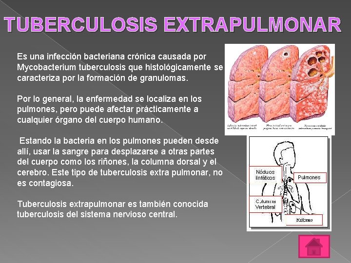 TUBERCULOSIS EXTRAPULMONAR Es una infección bacteriana crónica causada por Mycobacterium tuberculosis que histológicamente se