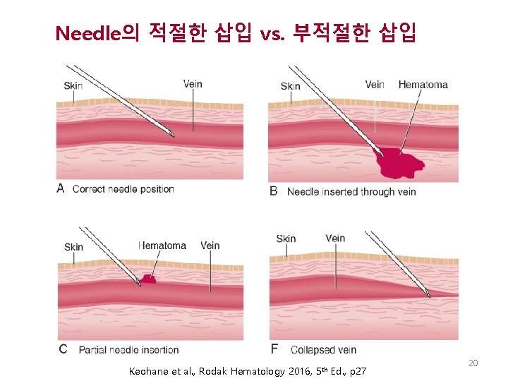 Needle의 적절한 삽입 vs. 부적절한 삽입 Keohane et al. , Rodak Hematology 2016, 5