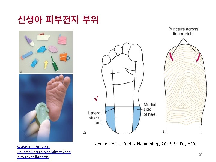 신생아 피부천자 부위 √ www. bd. com/enus/offerings/capabilities/spe cimen-collection Keohane et al. , Rodak Hematology