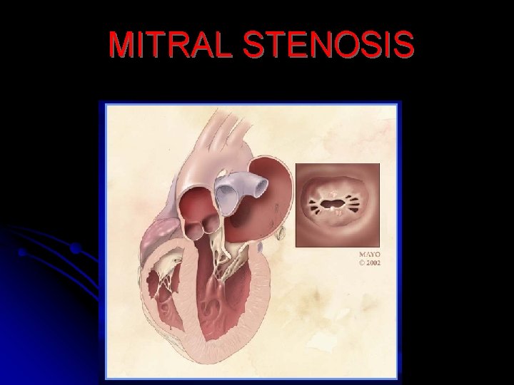 MITRAL STENOSIS 