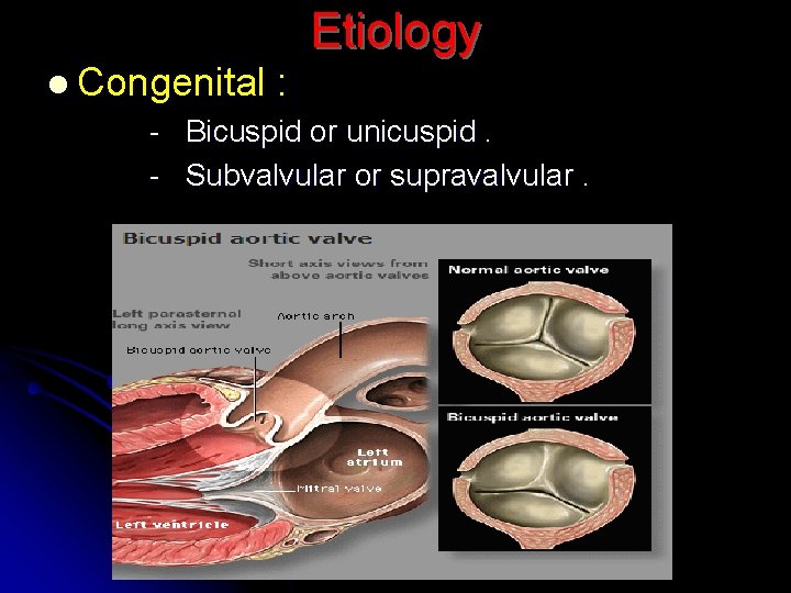 Etiology l Congenital : - Bicuspid or unicuspid. - Subvalvular or supravalvular. 