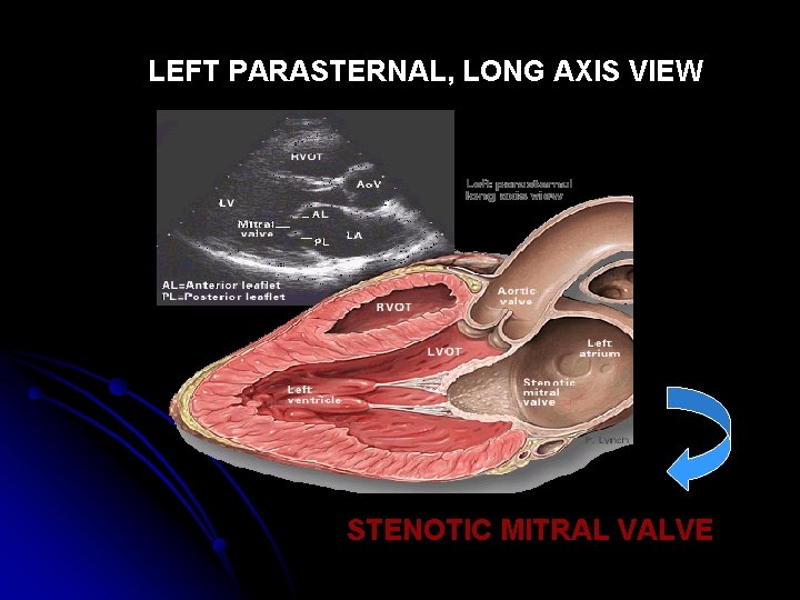 LEFT PARASTERNAL, LONG AXIS VIEW STENOTIC MITRAL VALVE 