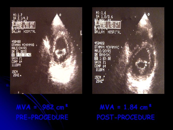 MVA =. 982 cm² MVA = 1. 84 cm² PRE-PROCEDURE POST-PROCEDURE 