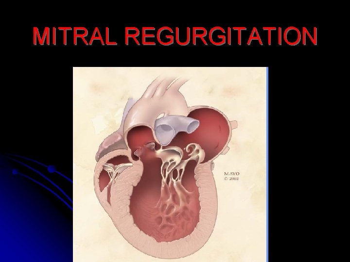 MITRAL REGURGITATION 