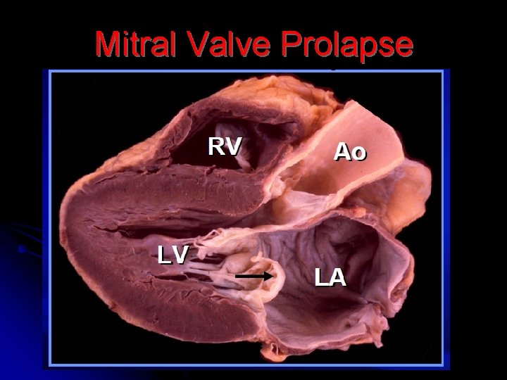 Mitral Valve Prolapse 