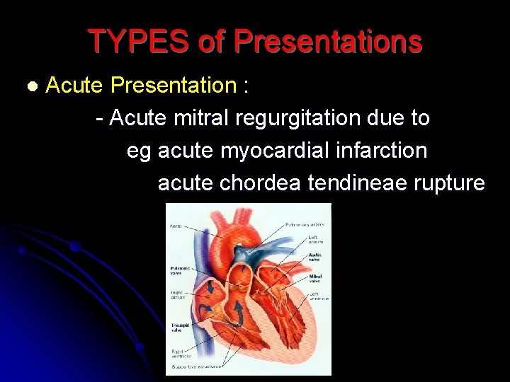 TYPES of Presentations l Acute Presentation : - Acute mitral regurgitation due to eg