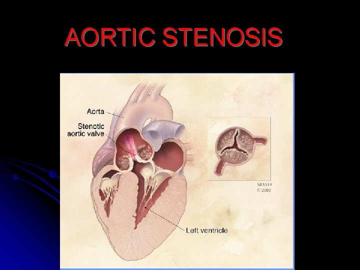 AORTIC STENOSIS 