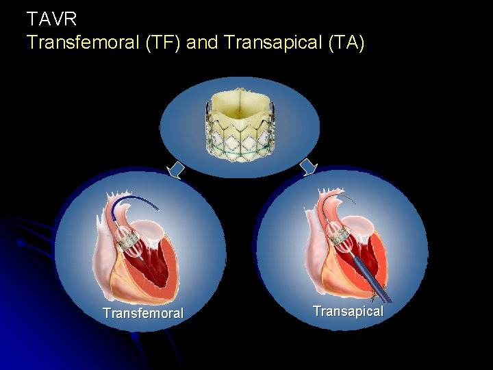 TAVR Transfemoral (TF) and Transapical (TA) Transfemoral Transapical 