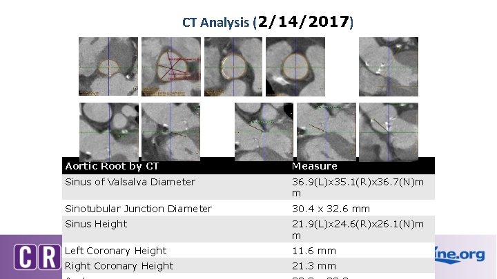 CT Analysis (2/14/2017) Aortic Root by CT Measure Sinus of Valsalva Diameter 36. 9(L)x