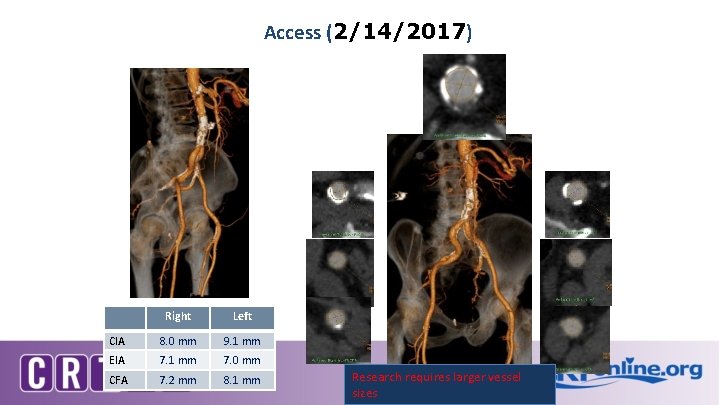 Access (2/14/2017) Right Left CIA 8. 0 mm 9. 1 mm EIA 7. 1