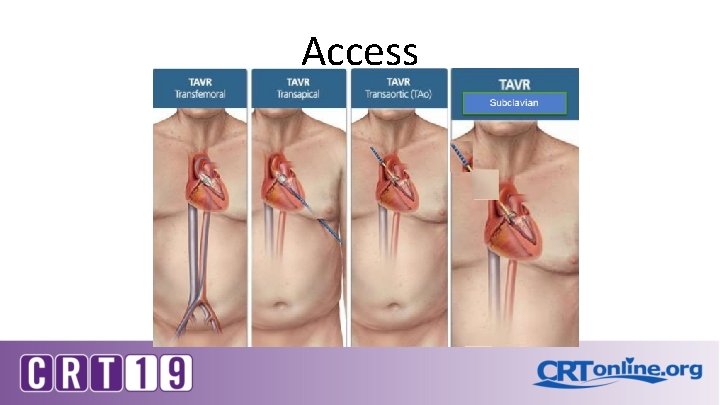 Access 