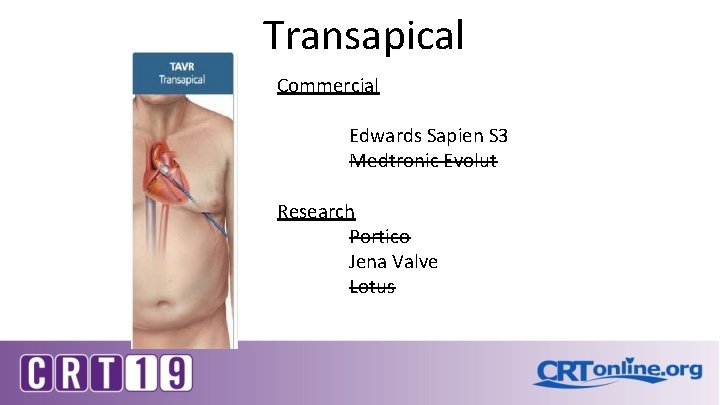 Transapical Commercial Edwards Sapien S 3 Medtronic Evolut Research Portico Jena Valve Lotus 