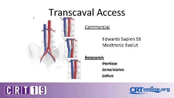 Transcaval Access Commercial Edwards Sapien S 3 Medtronic Evolut Research Portico Jena Valve Lotus