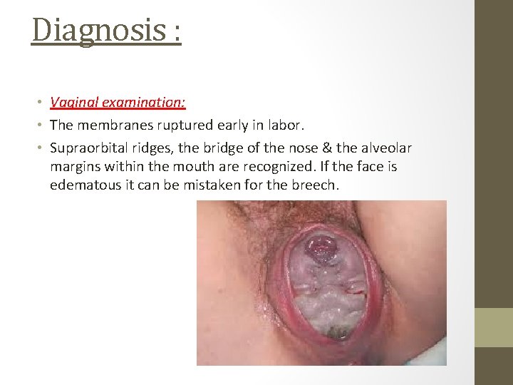 Diagnosis : • Vaginal examination: • The membranes ruptured early in labor. • Supraorbital