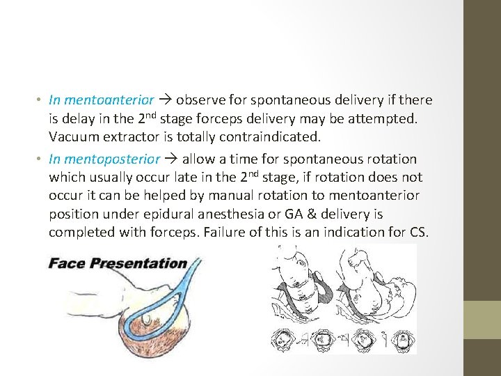  • In mentoanterior observe for spontaneous delivery if there is delay in the