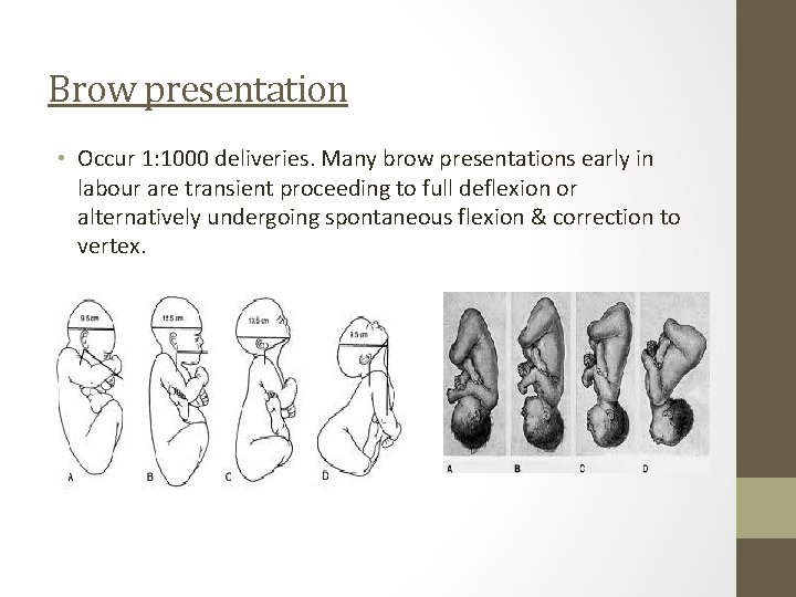 Brow presentation • Occur 1: 1000 deliveries. Many brow presentations early in labour are