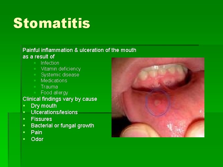 Stomatitis Painful inflammation & ulceration of the mouth as a result of § §