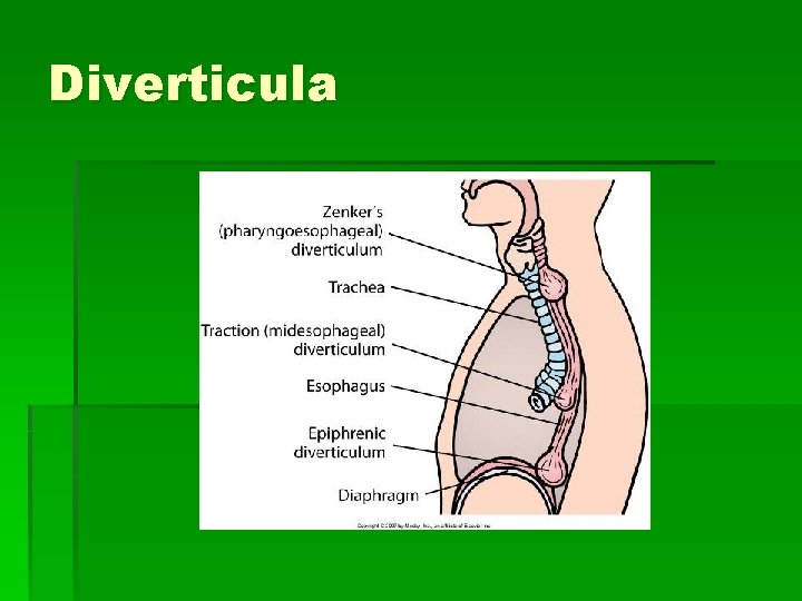Diverticula 