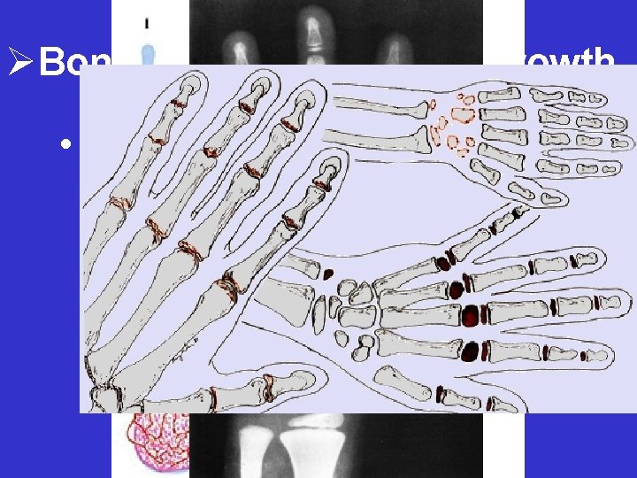 ØBone Development and Growth • Endochondral ossification – Cartilage converted into bone 