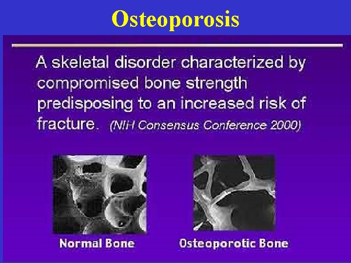 Osteoporosis 