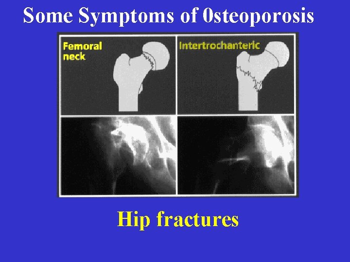 Some Symptoms of 0 steoporosis Hip fractures 