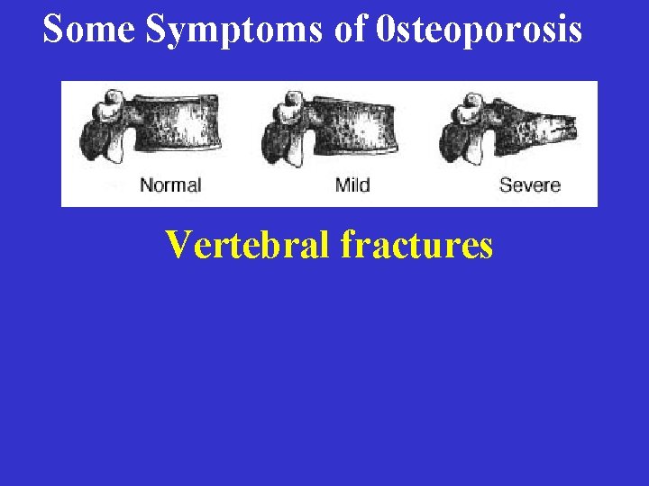 Some Symptoms of 0 steoporosis Vertebral fractures 