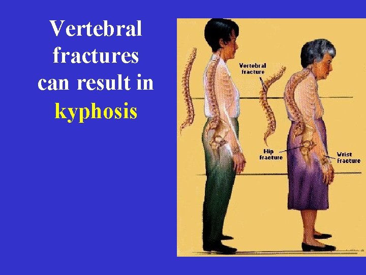 Vertebral fractures can result in kyphosis 
