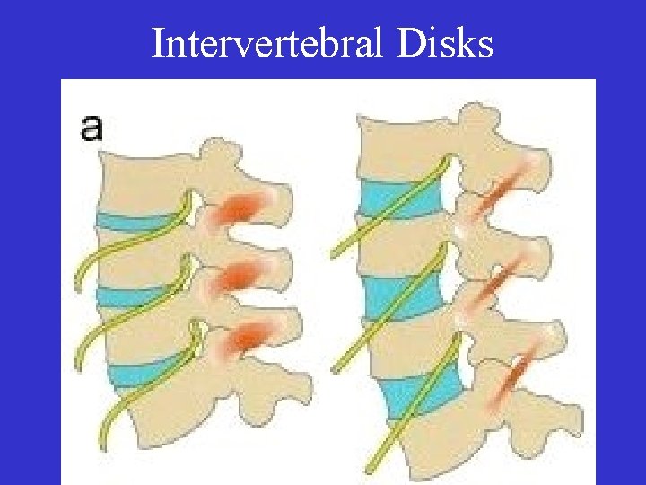 Intervertebral Disks 