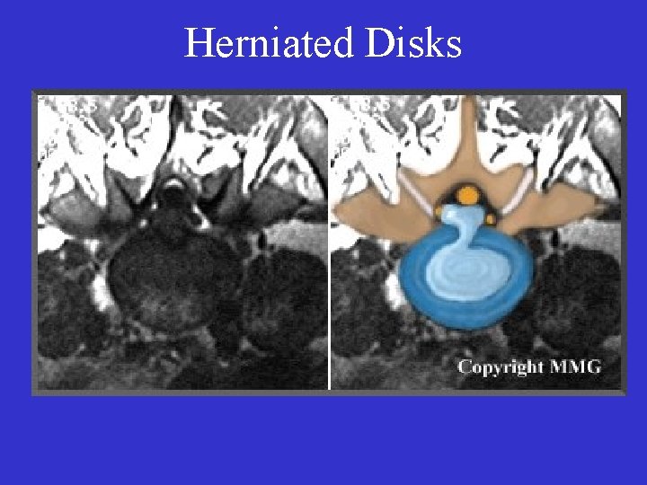 Herniated Disks 