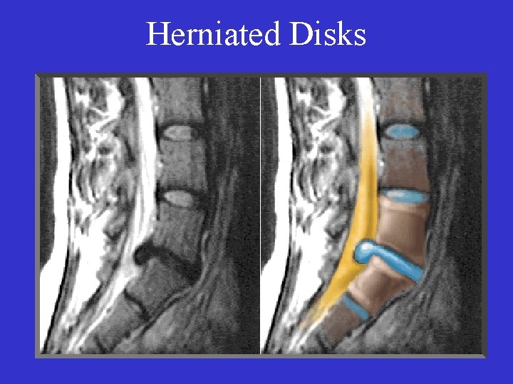 Herniated Disks 