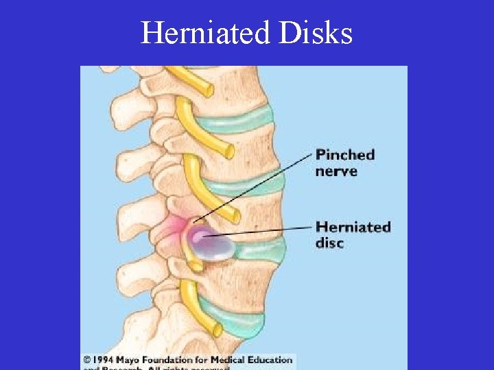 Herniated Disks 