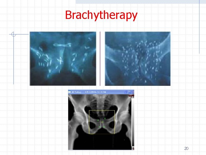 Brachytherapy 20 